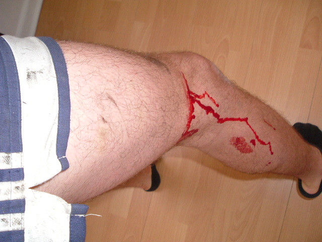 'Tip of the week' Don't wear shorts when car breaking! D'oh!