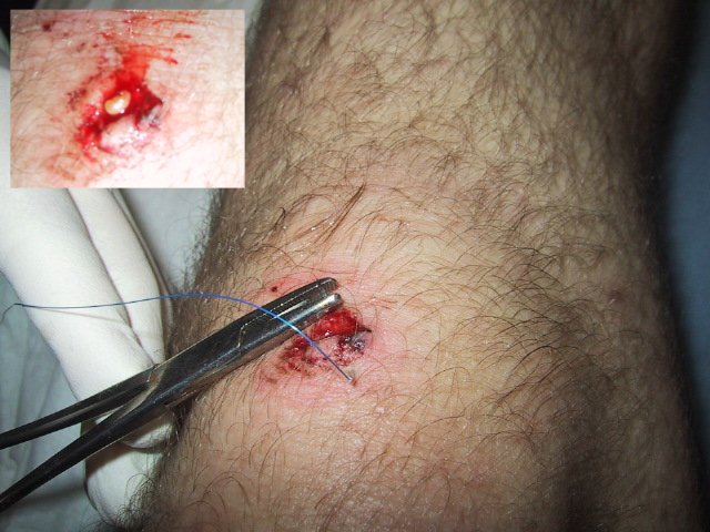 knee with inset